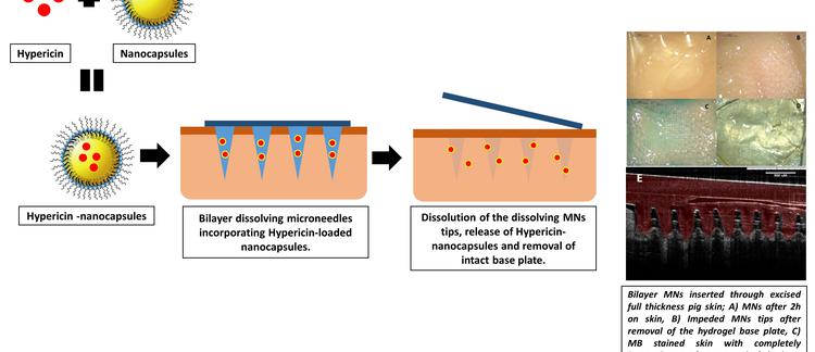 Bilayer Dissolving Microneedles Incorporating Hypericin-Loaded Nanocapsules For Improved Localised Photodynamic Therapy